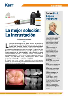 MKT-25-0236_Kerr-Putignano-NX3-Clinical-Case_210x297mm ES_Page_1