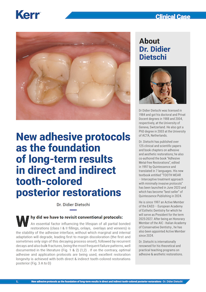 Clinical Case – Immediate Dentin Sealing
